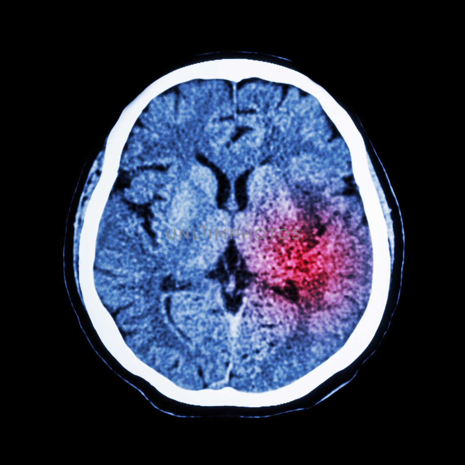 CT scan of brain show Ischemic Stroke or Hemorrhagic Stroke by stockdevil