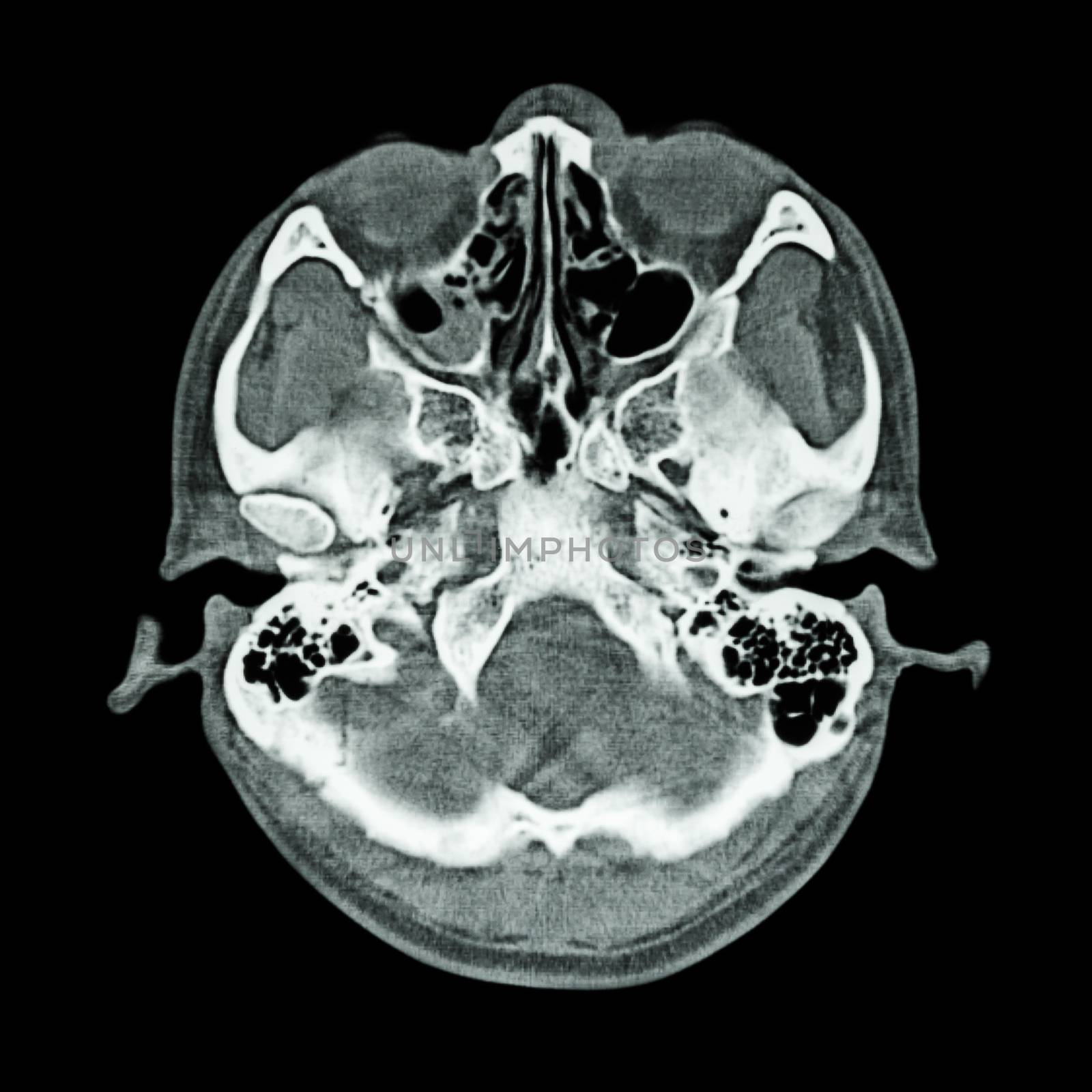 CT scan of brain and base of skull ( Bone window ) by stockdevil