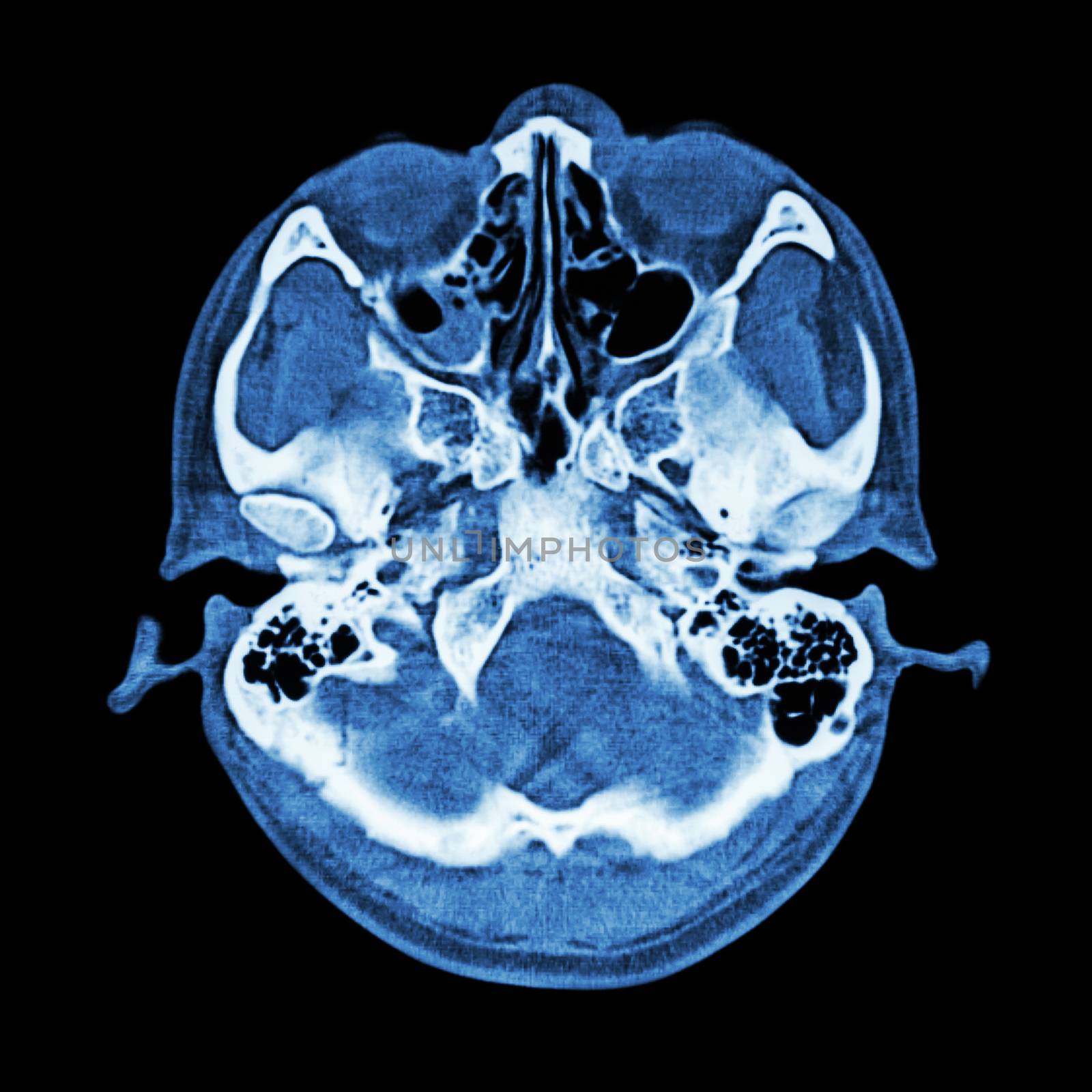 CT scan of brain and base of skull ( Bone window )