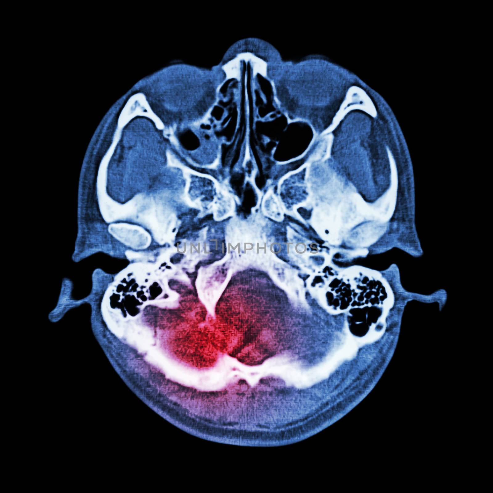 Brain injury, Stroke : ( CT scan of brain and base of skull ) ( Bone window )