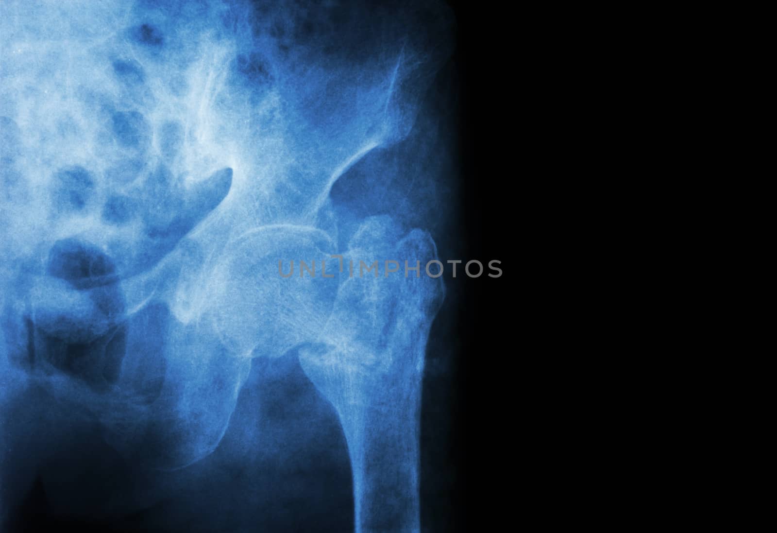 intertrochanteric ( Neck of femur ) fracture left femur ( Thigh bone ) and blank area at right side