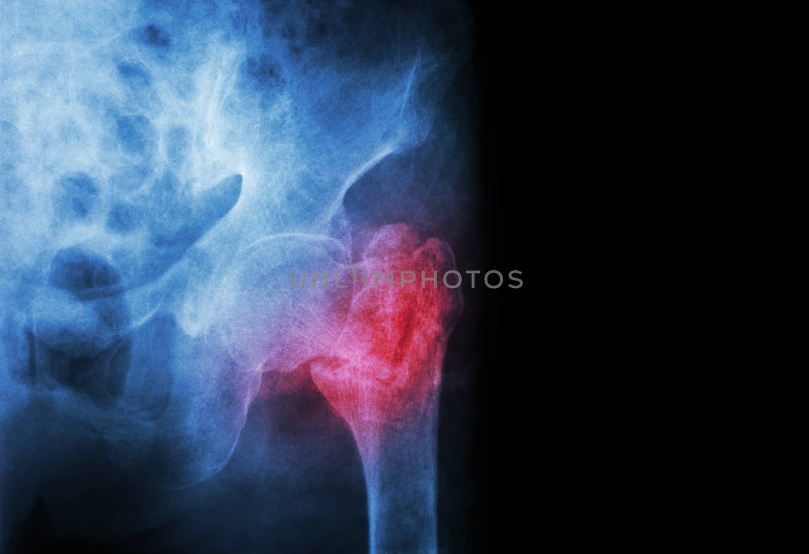 intertrochanteric ( Neck of femur ) fracture left femur ( Thigh bone ) and blank area at right side