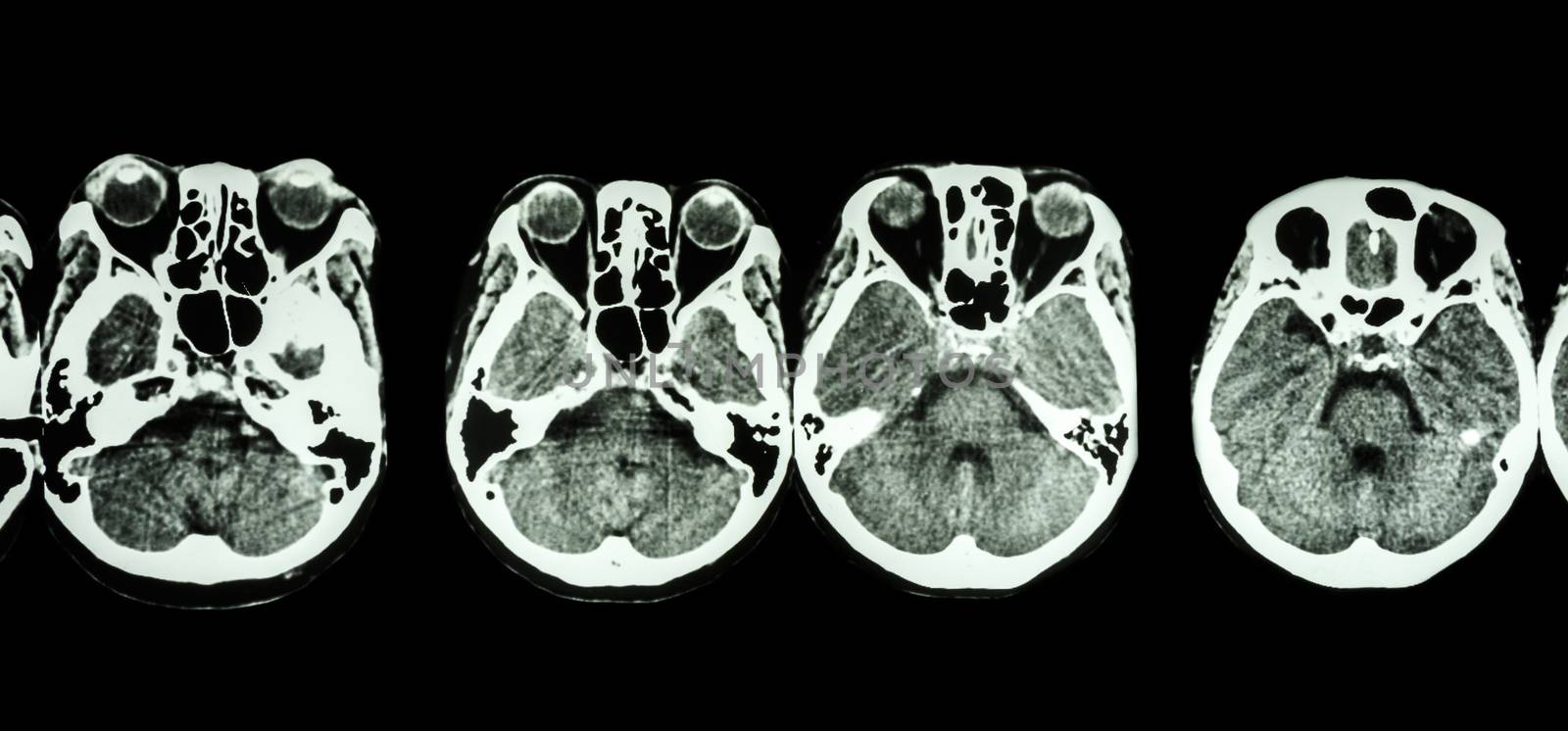 CT scan of brain and base of skull ( show structure of eye , ethmoid sinus , cerebellum , cerebrum, etc )