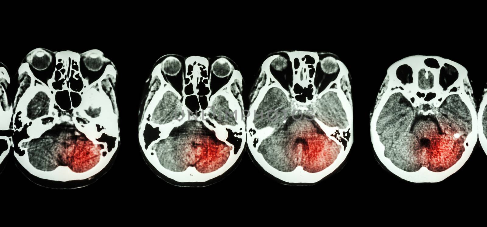 Stroke ( CT scan of brain and base of skull and Stroke )