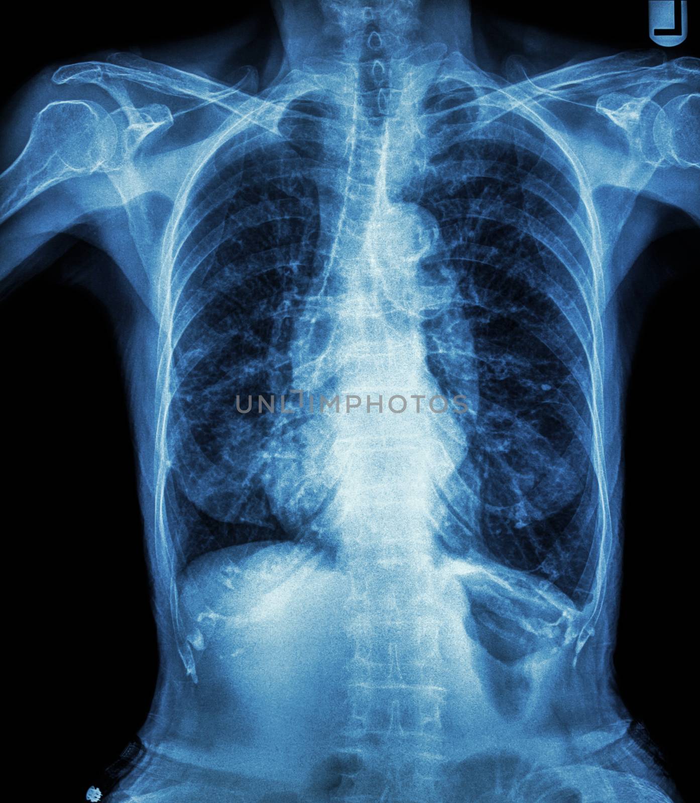 Chest X-ray of old patient ( calcification at rib , trachea , bronchus )