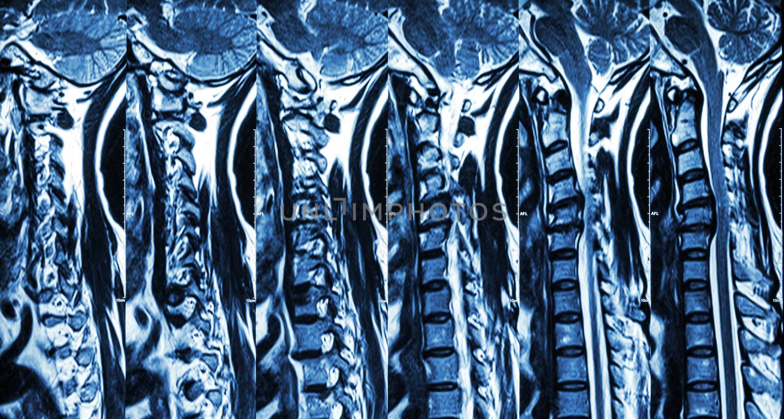 Cervical spondylosis with disc herniation ( MRI of cervical spine : show cervical spondylosis with disc herniation compress spinal cord ( Myelopathy ) )