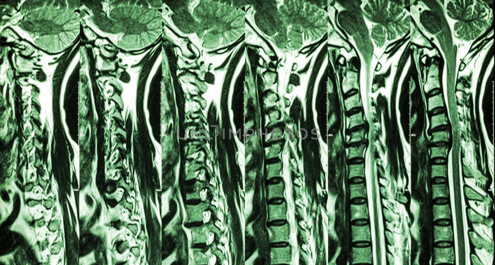 Cervical spondylosis with disc herniation ( MRI of cervical spine : show cervical spondylosis with disc herniation compress spinal cord ( Myelopathy ) )