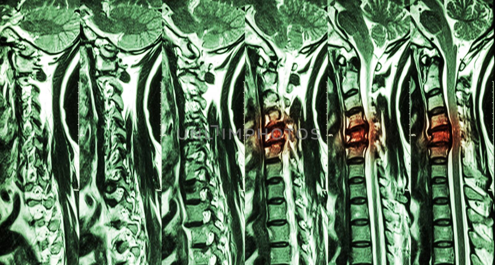 Cervical spondylosis with disc herniation ( MRI of cervical spine : show cervical spondylosis with disc herniation compress spinal cord ( Myelopathy ) )