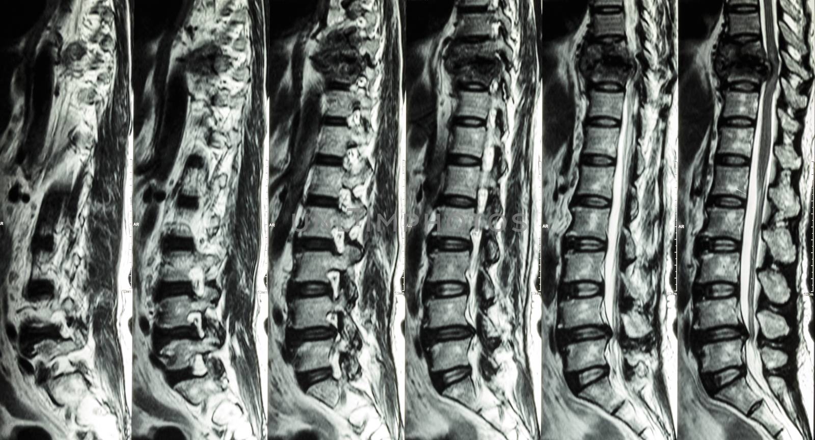 MRI of Lumbar & Thoracic spine : show fracture of thoracic spine and compress spinal cord ( Myelopathy )