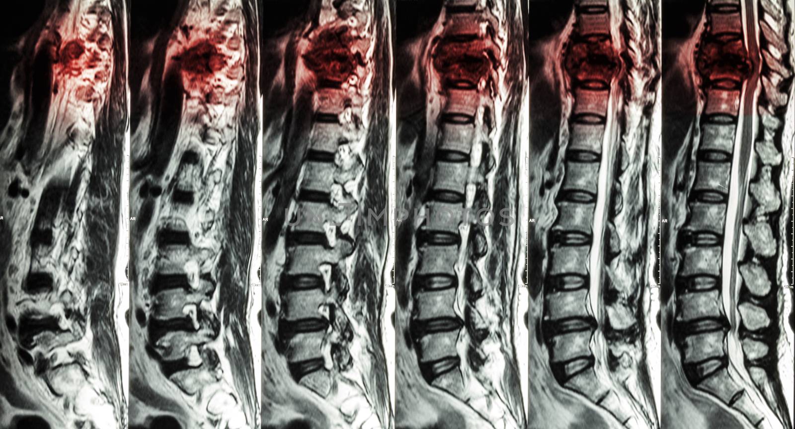 MRI of Lumbar & Thoracic spine : show fracture of thoracic spine and compress spinal cord ( Myelopathy )