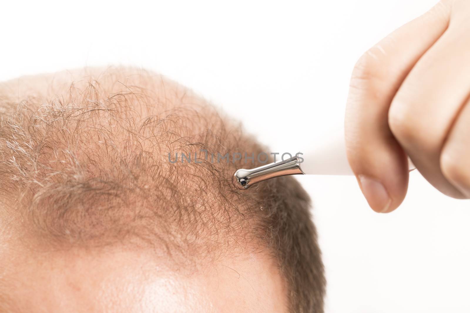 Baldness Alopecia man hair loss  by CatherineL-Prod