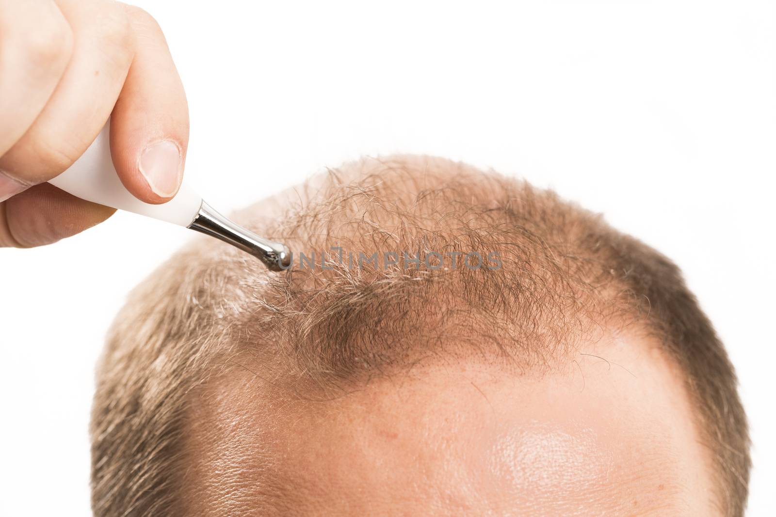 Baldness Alopecia man hair loss medicine bald treatment transplantation France