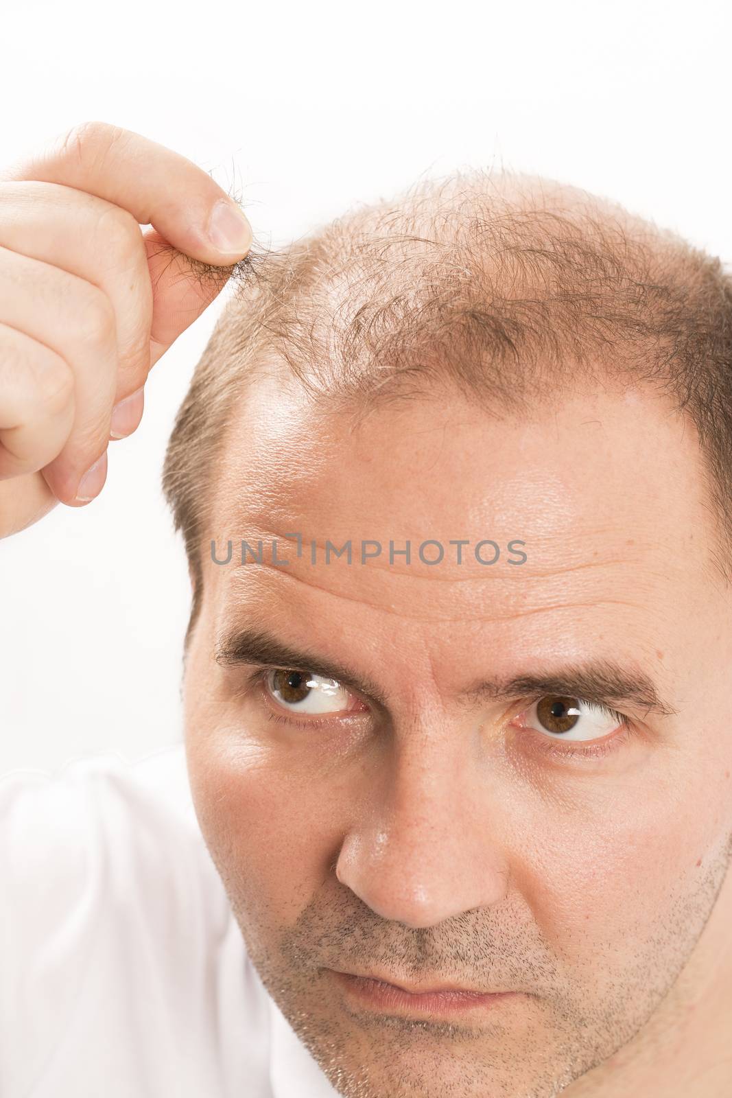 Baldness Alopecia man hair loss medicine bald treatment transplantation France