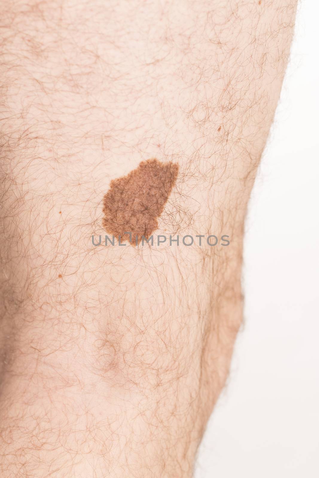 Melanoma angioma beauty mark spot on man skin France