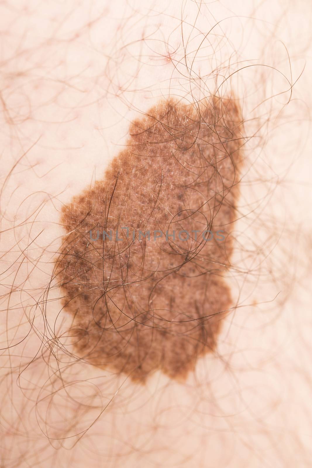 Melanoma angioma beauty mark by CatherineL-Prod