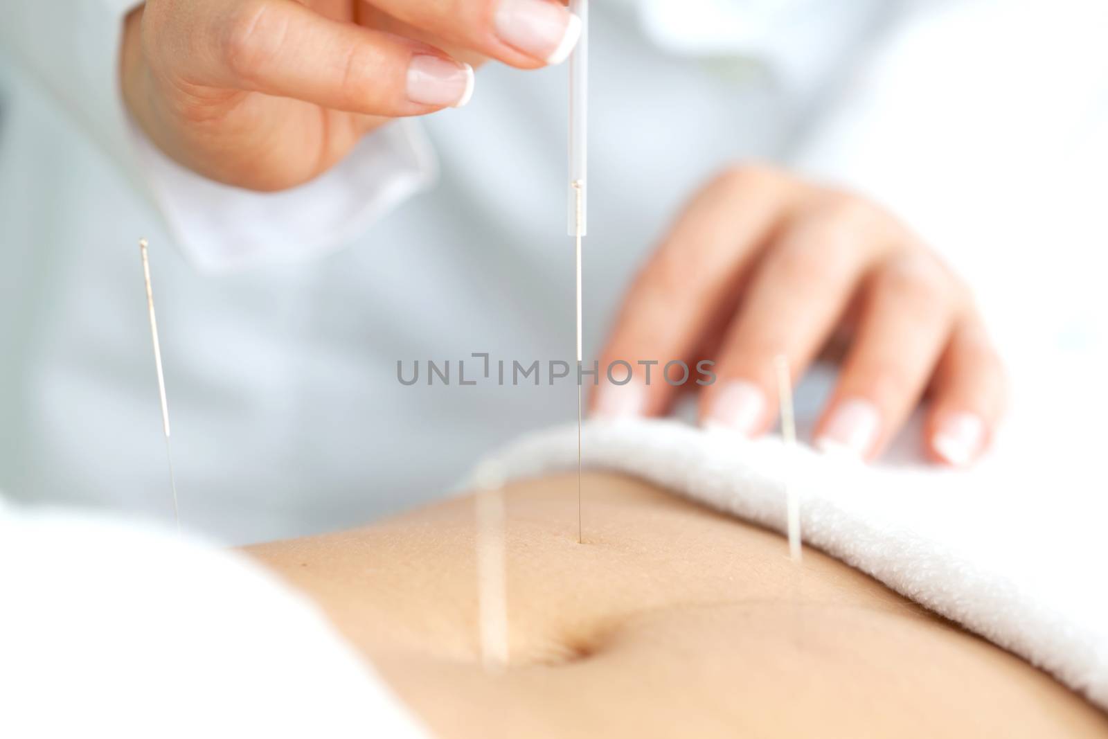 Doctor applying acupuncture on a patient's abdomen