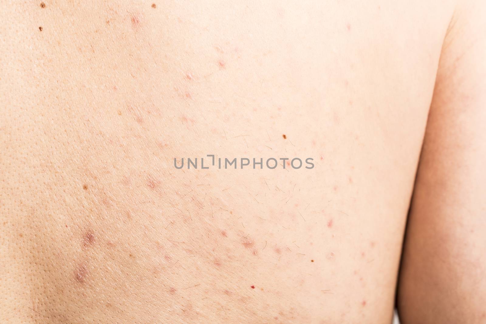 acne on mature  male back treatment infection