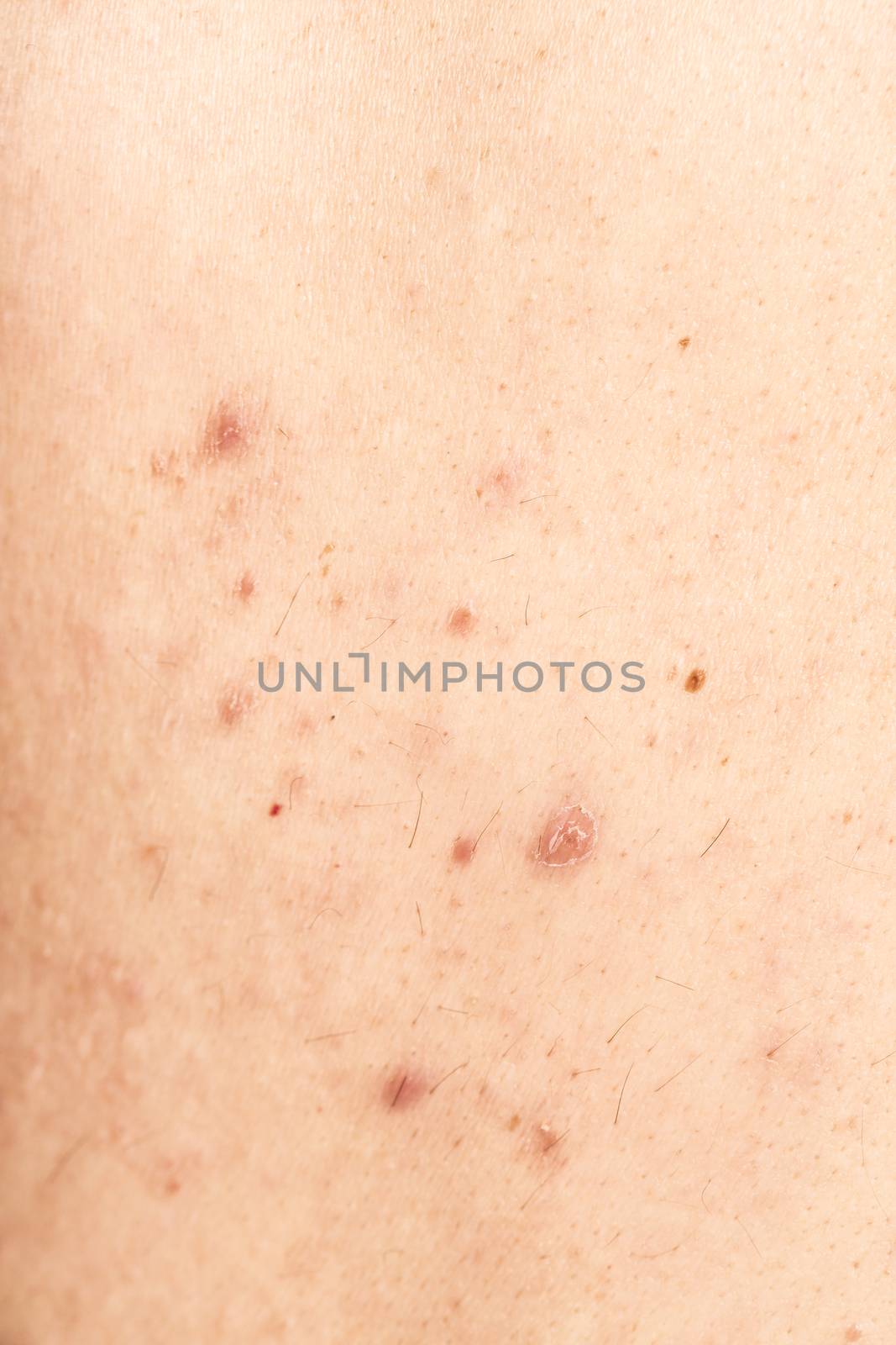 acne on male man back by CatherineL-Prod