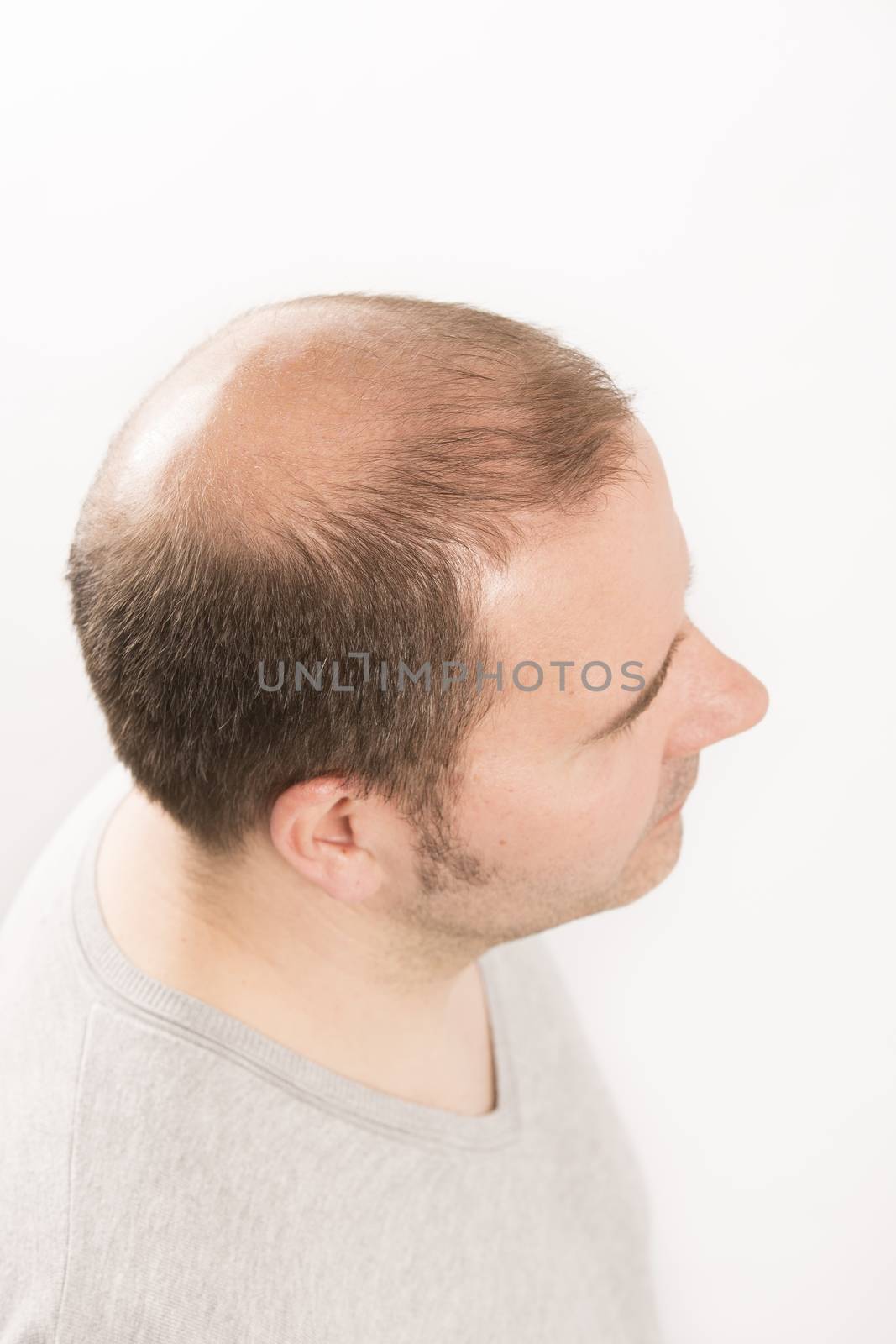 Baldness Alopecia man hair loss haircare  by CatherineL-Prod