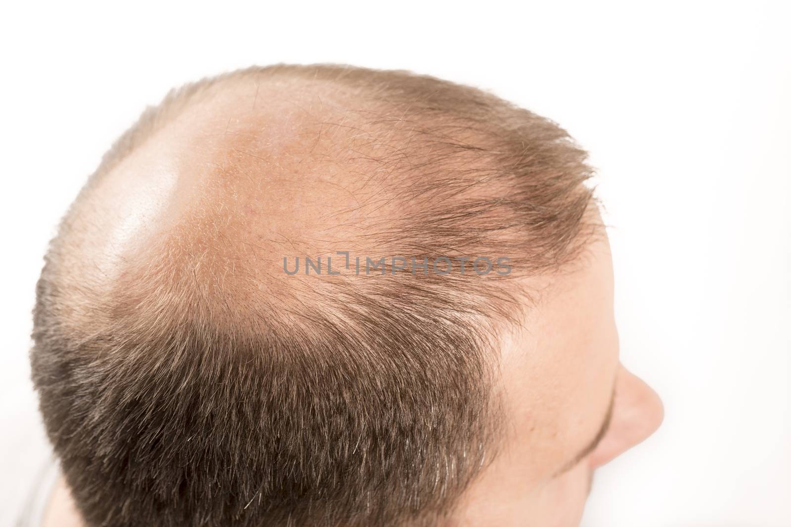 Baldness Alopecia man hair loss haircare medicine bald treatment transplantation