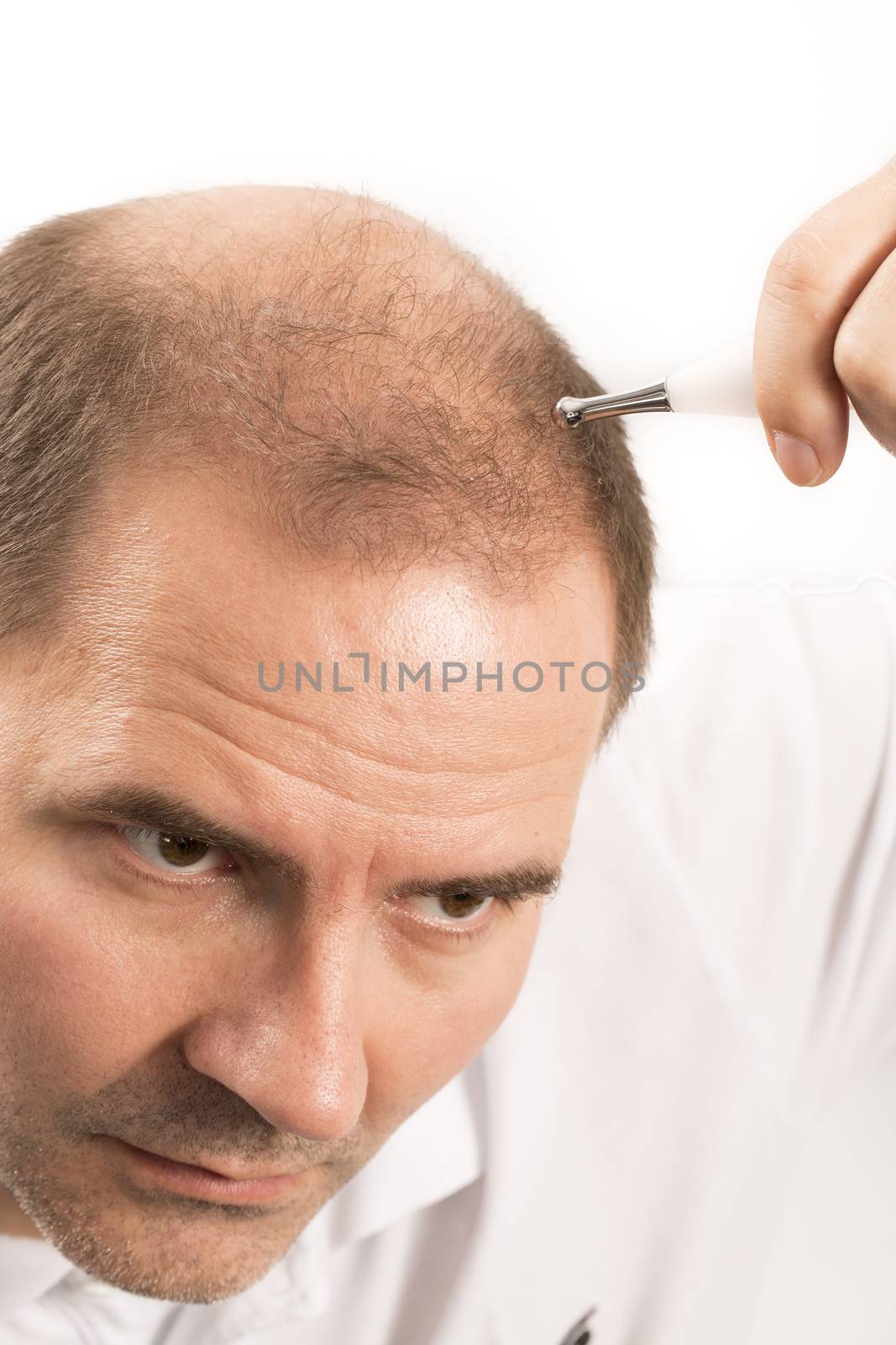 Baldness Alopecia man hair loss haircare  by CatherineL-Prod