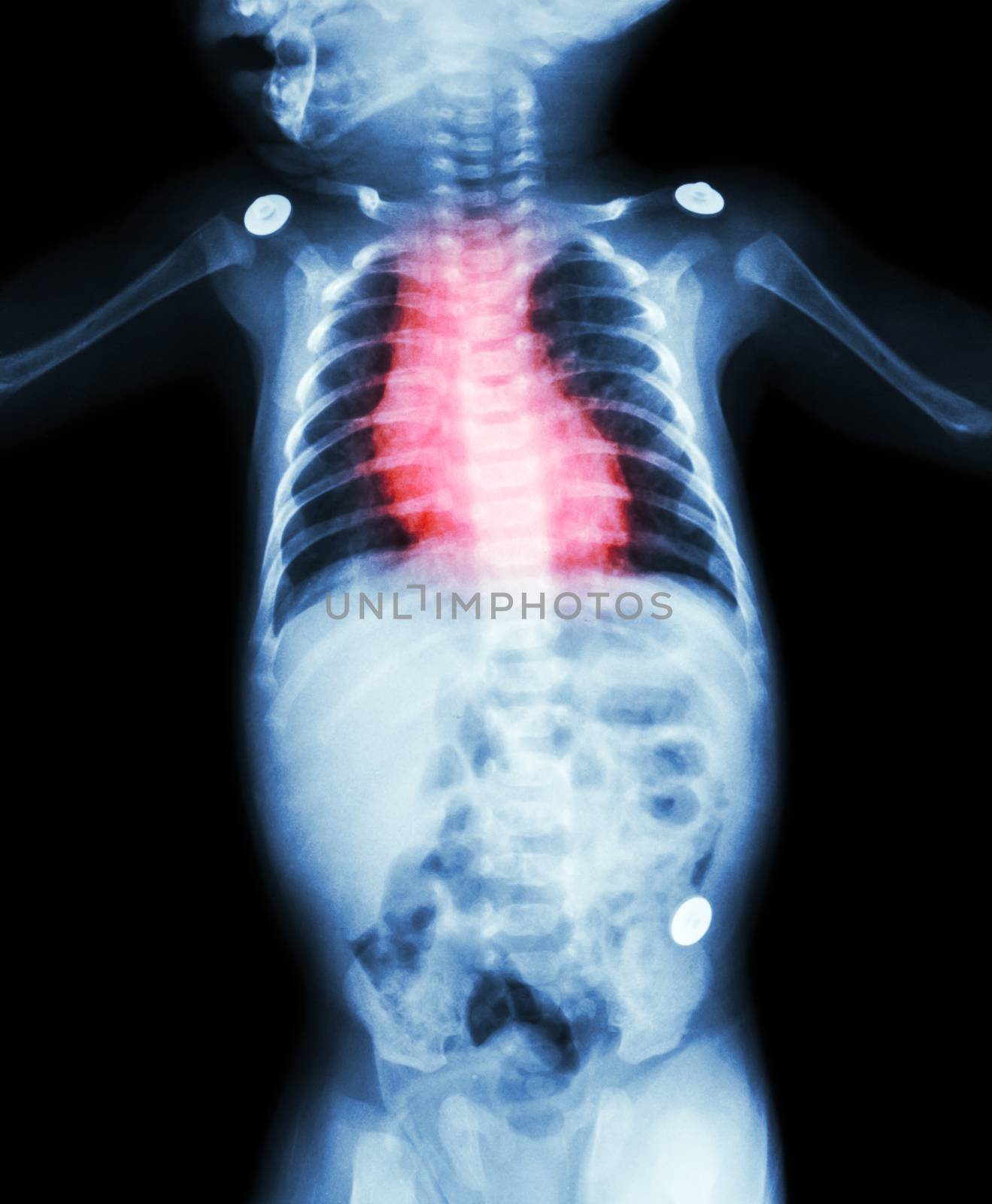 Congenital Heart Disease , Rheumatic Heart Disease ( X-ray body of child and red color on heart area )