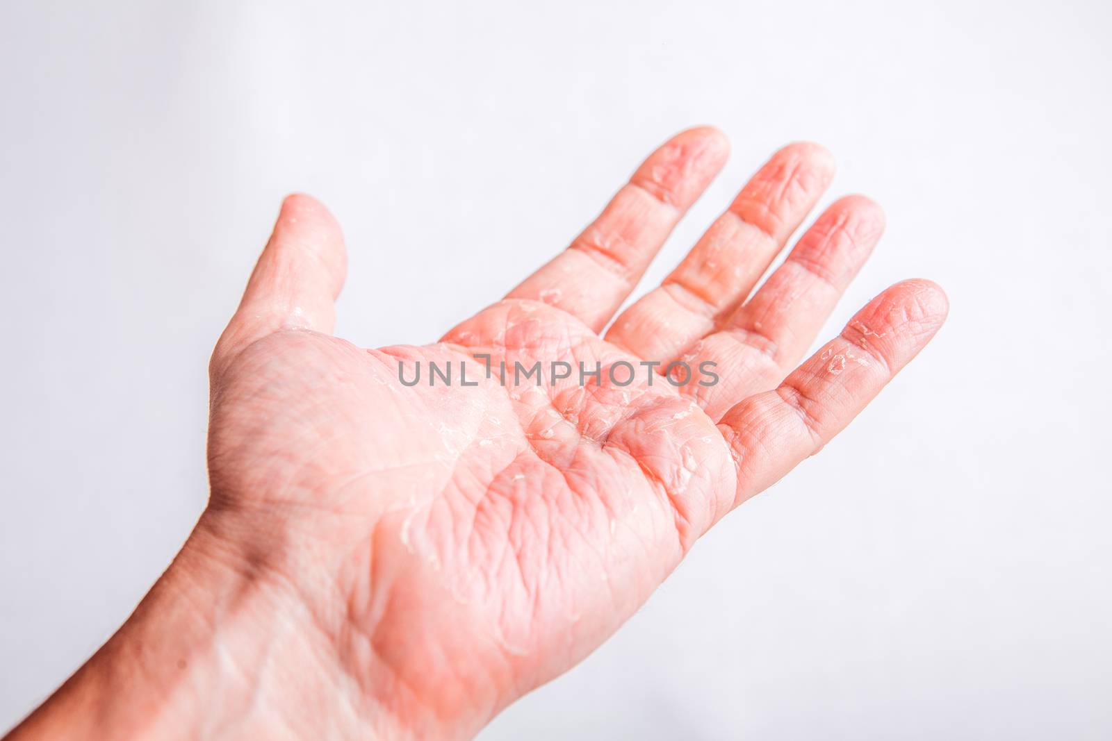 The problem with many people - eczema on hand. Isolated background.