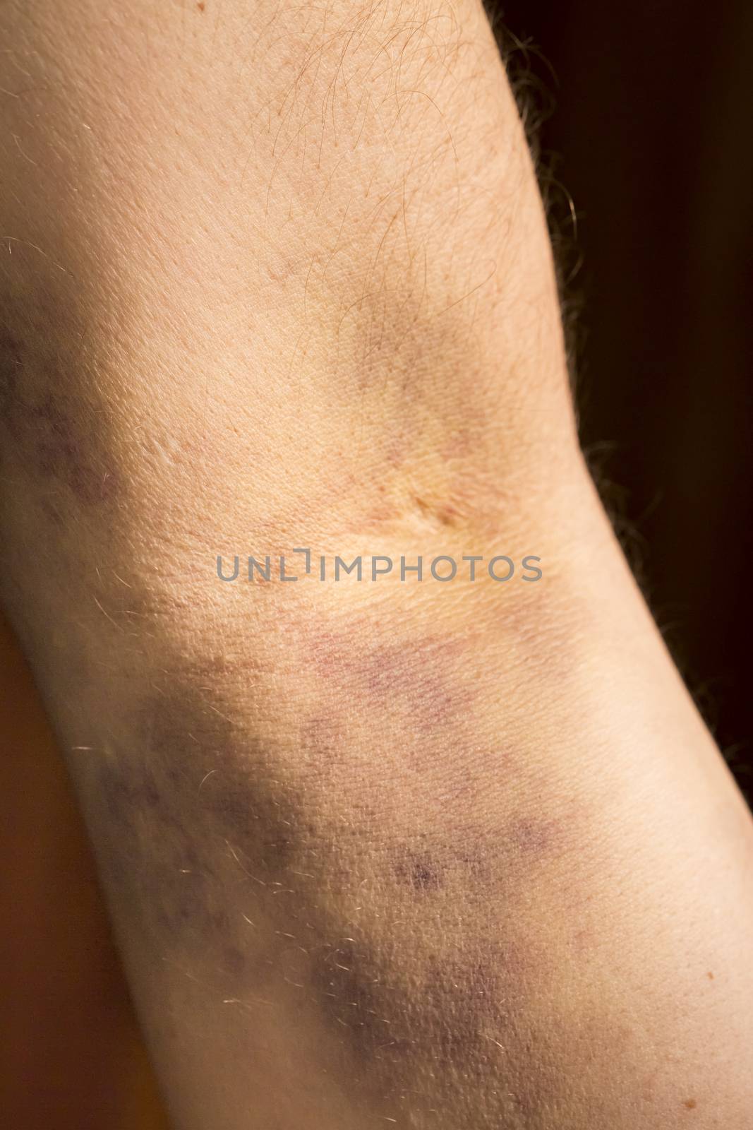 large hematoma on human arm after blood test black background