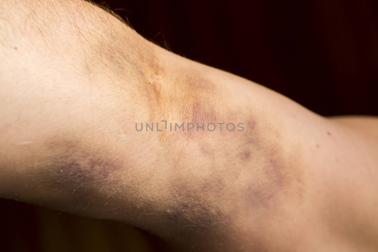 large hematoma on human arm after blood test black background