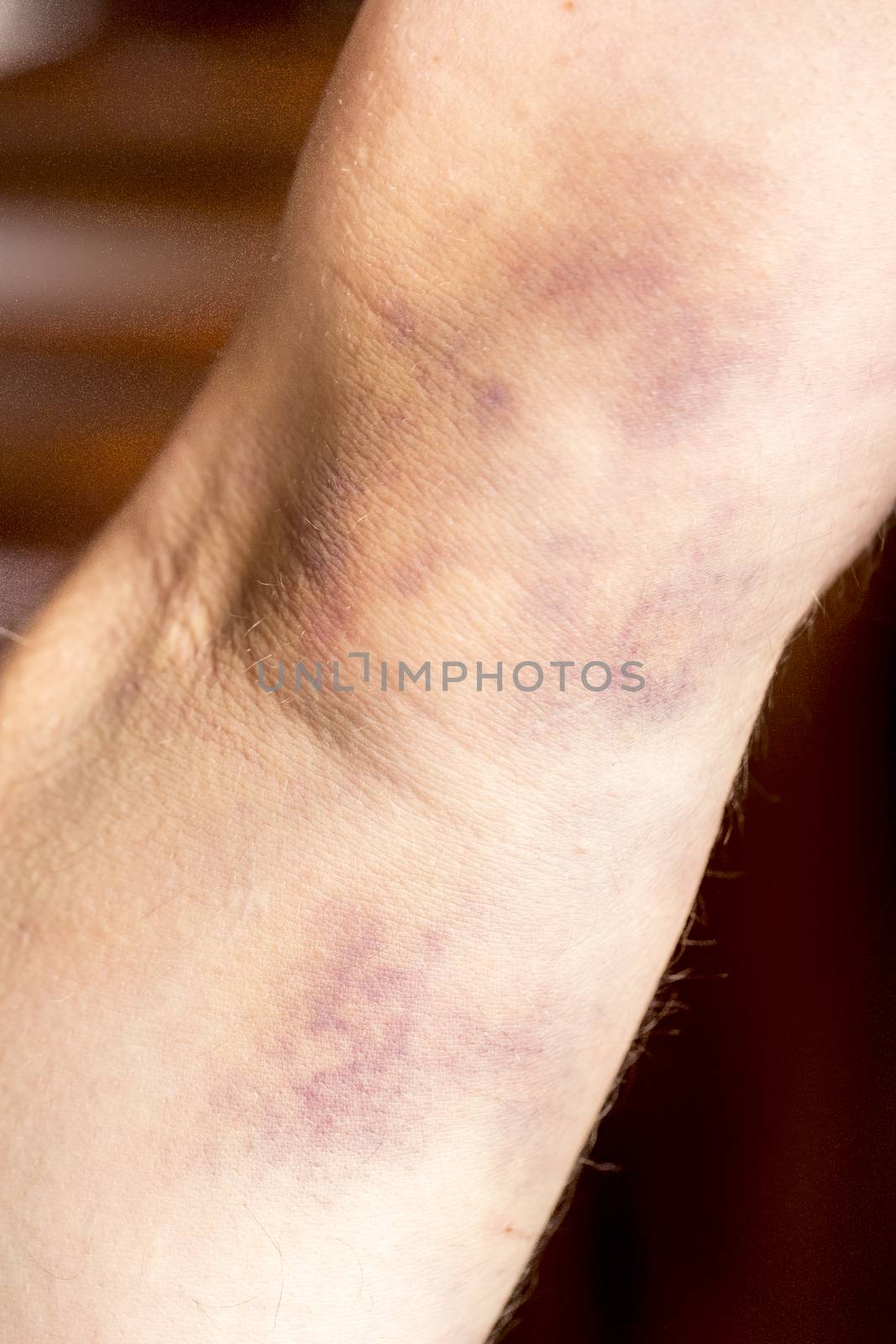 large hematoma on human arm by CatherineL-Prod