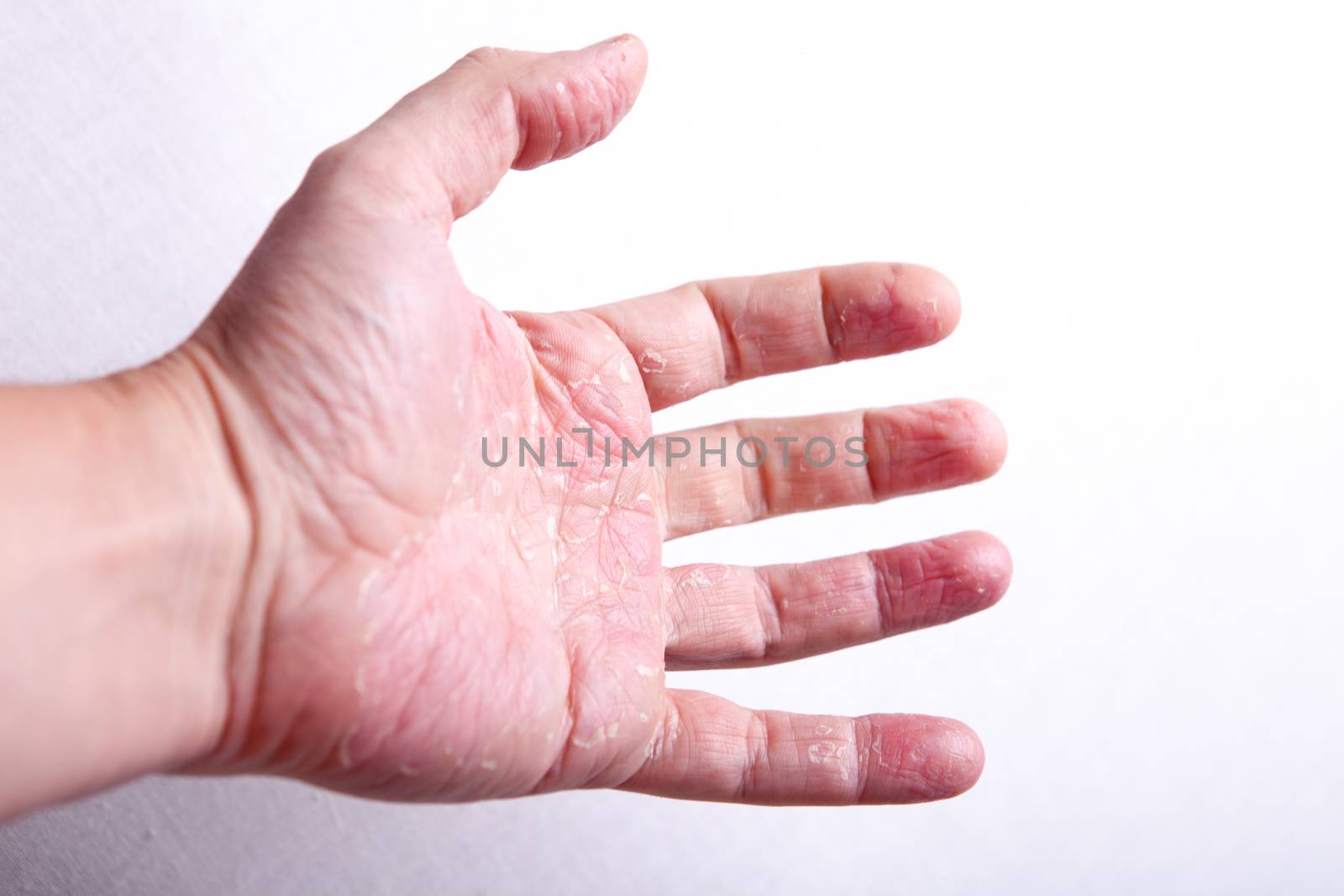 allergic rash dermatitis skin texture of patient by traza