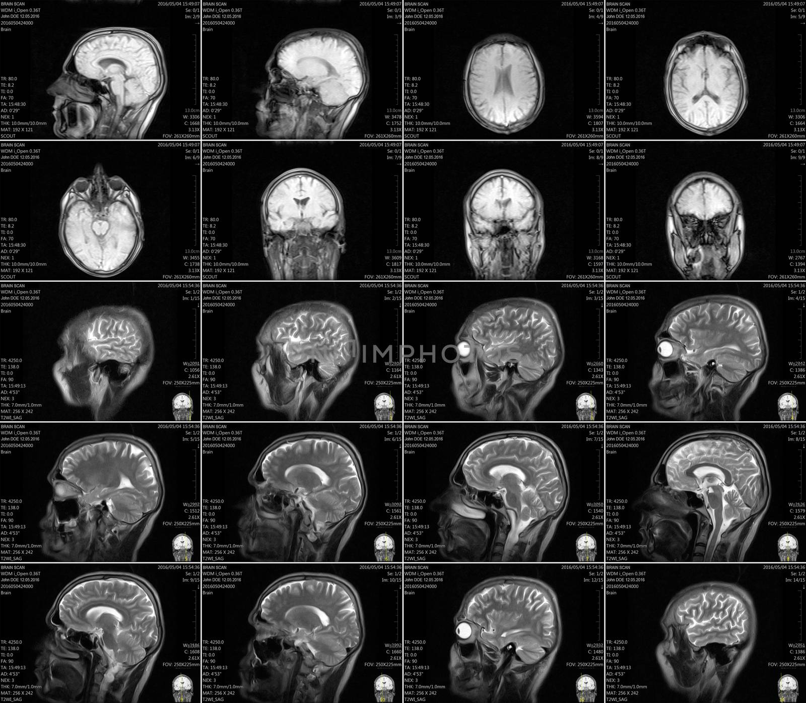 Magnetic resonance imaging of the brain with no visible abnormalities. MRI in different views