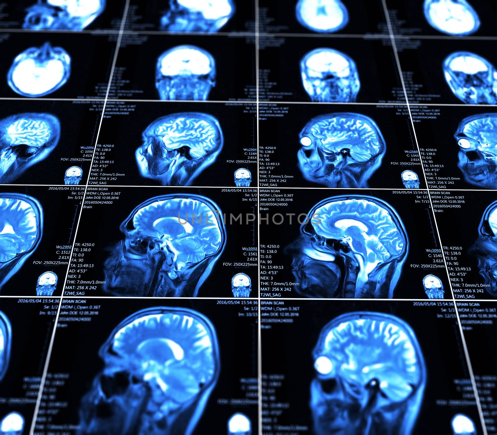 Magnetic resonance imaging of the brain with no visible abnormalities. MRI in different views