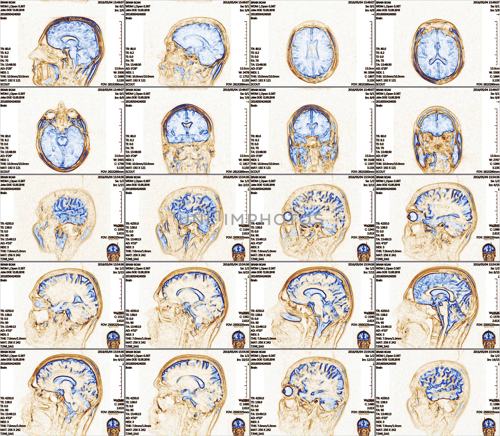 Magnetic resonance imaging of the brain with no visible abnormalities. MRI in different views