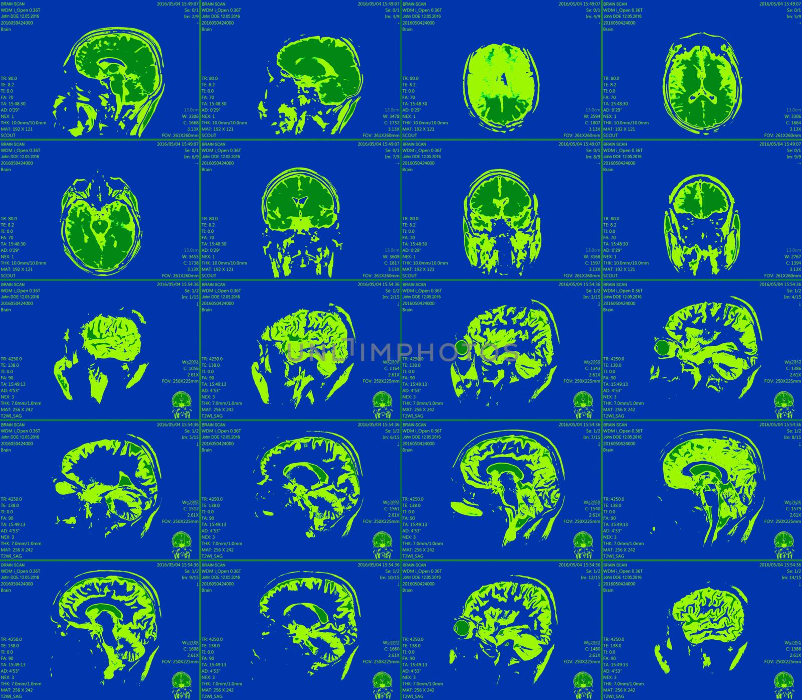 Magnetic resonance imaging of the brain with no visible abnormalities. MRI in different views