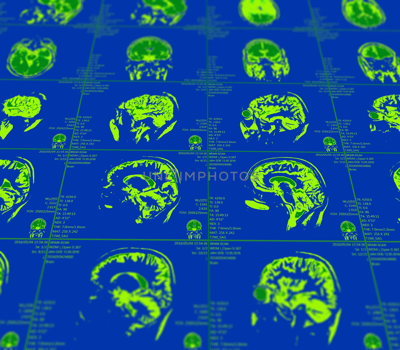 Magnetic resonance imaging of the brain with no visible abnormalities. MRI in different views