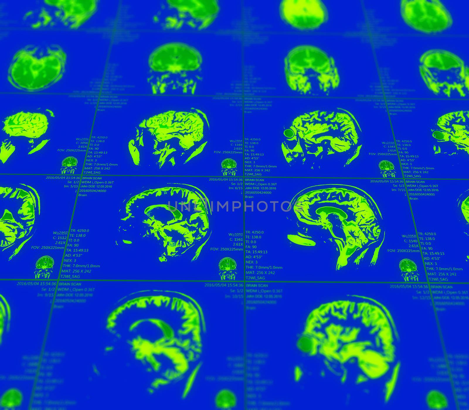 Magnetic resonance imaging of the brain with no visible abnormalities. MRI in different views