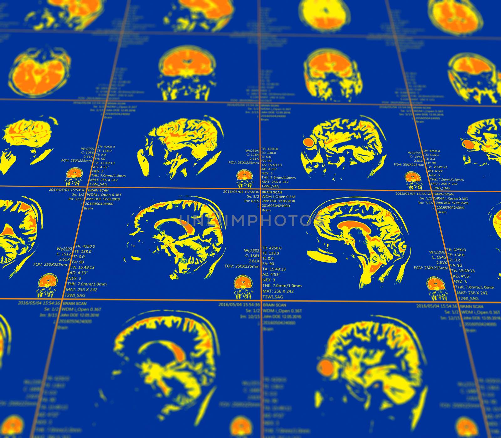 Magnetic resonance imaging of the brain with no visible abnormalities. MRI in different views