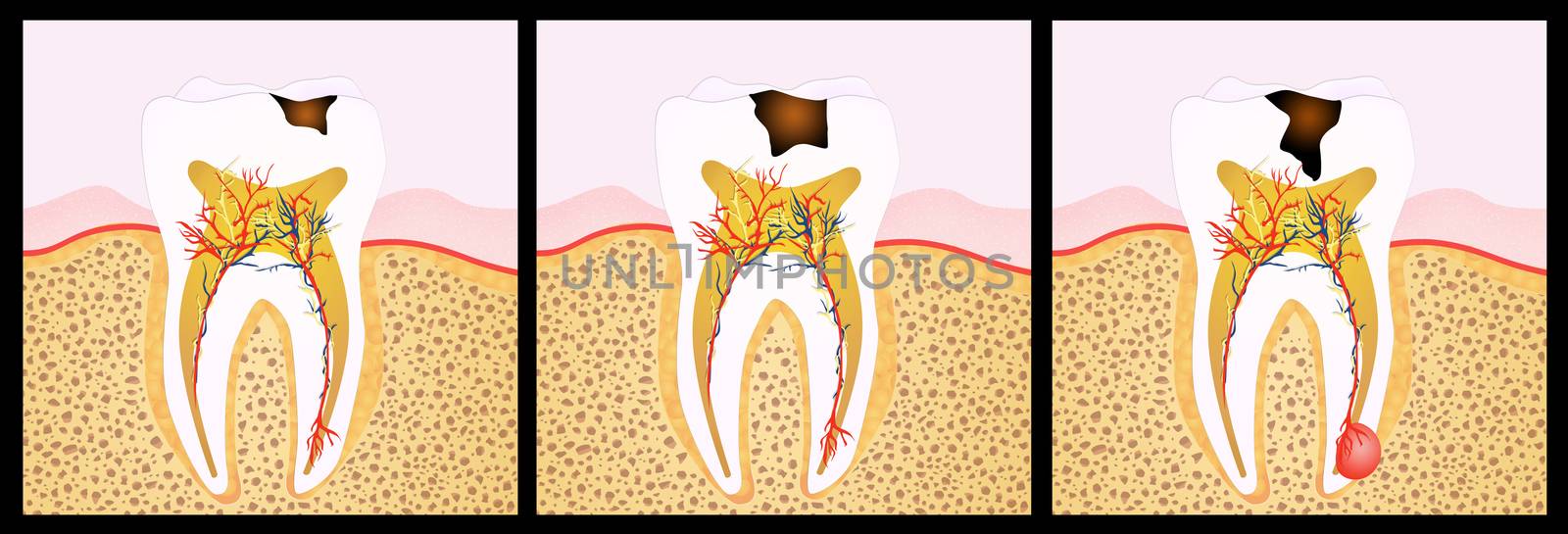 illustration of tooth decay scheme