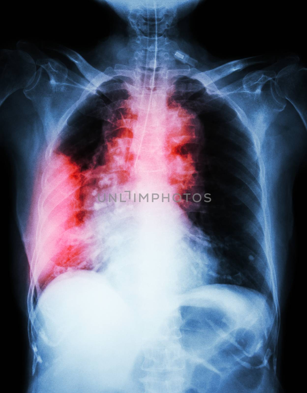 Lung cancer . Film chest x-ray show right lung mass , wide mediastinum , pneumonia and right pleural effusion