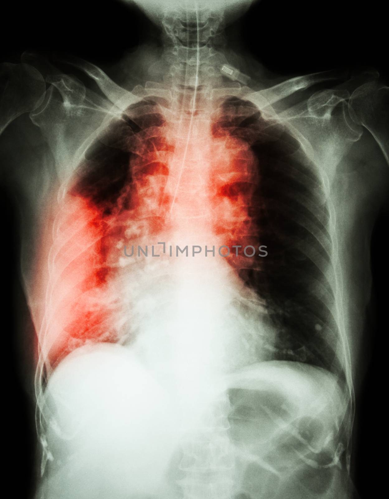 Lung cancer . Film chest x-ray show right lung mass , wide mediastinum , pneumonia and right pleural effusion