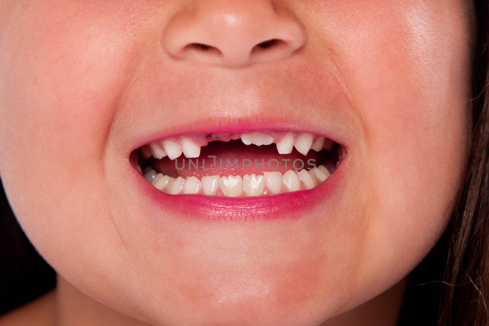 Happy open mouth with missing teeth exchanging milk tooth for adult tooth growing up, dental concept.