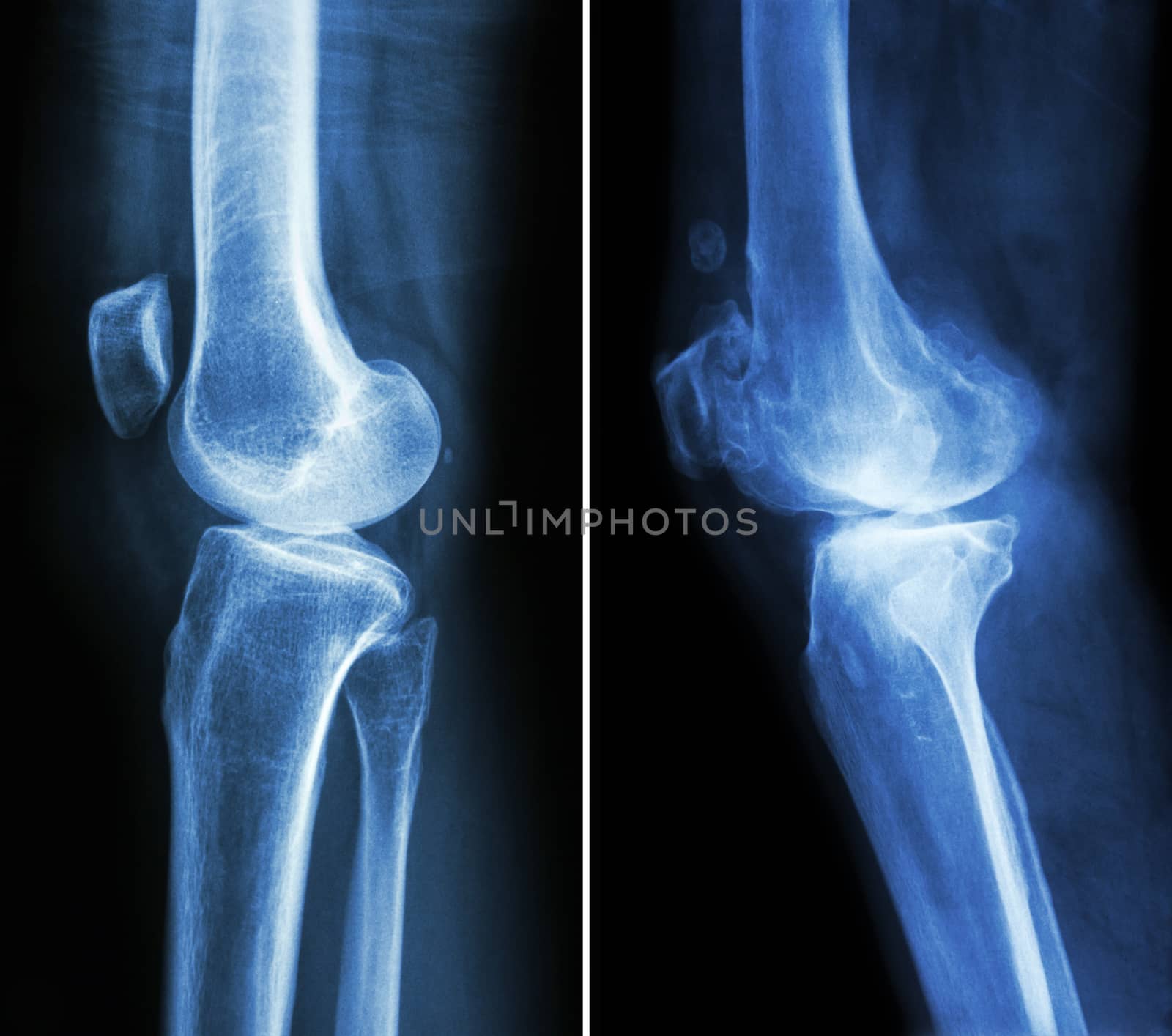 normal knee ( left image ) and osteoarthritis knee ( right image ) ( lateral view )