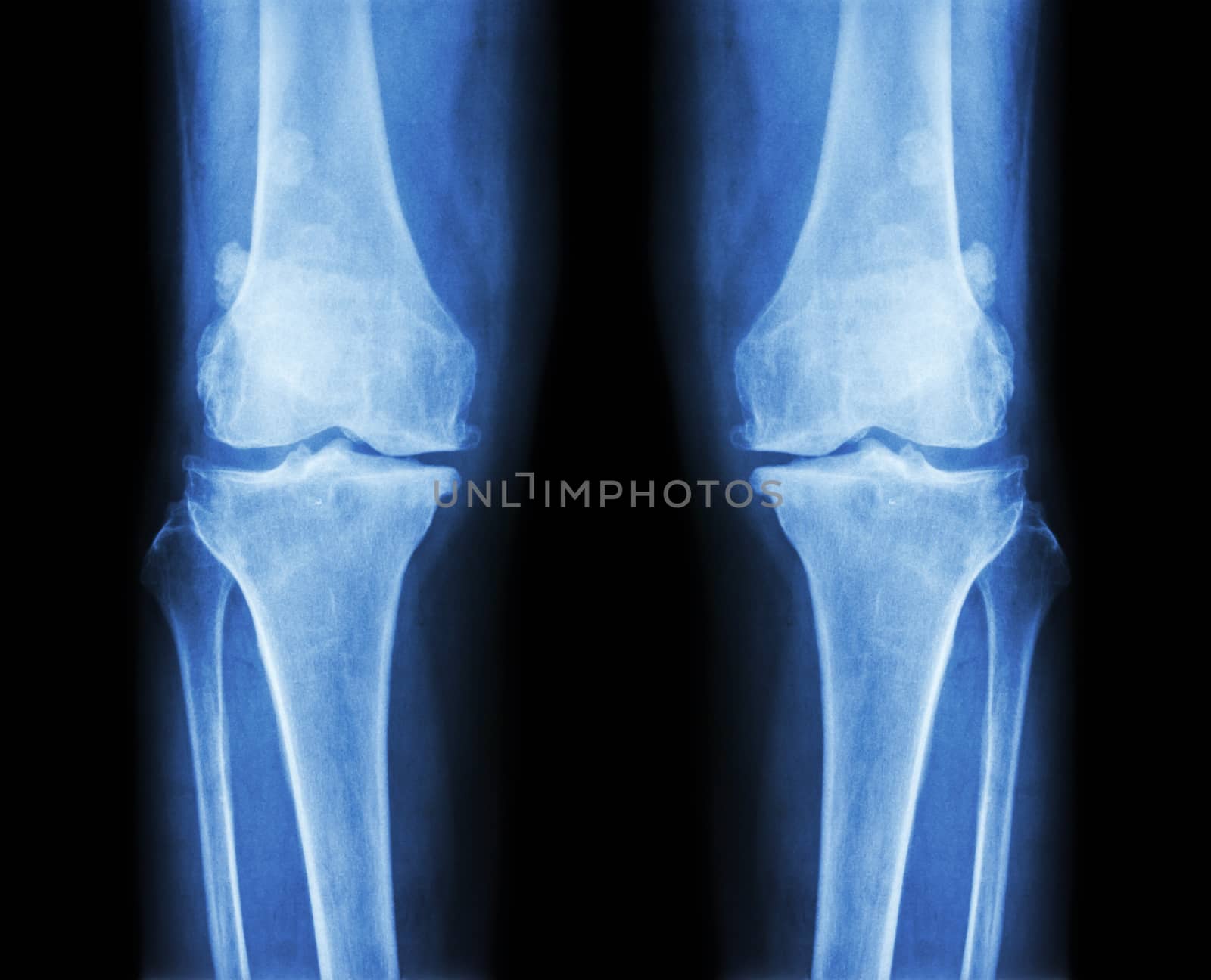 Osteoarthritis both knee . film x-ray AP ( anterior - posterior ) of knee show narrow joint space , osteophyte ( spur ) , subcondral sclerosis