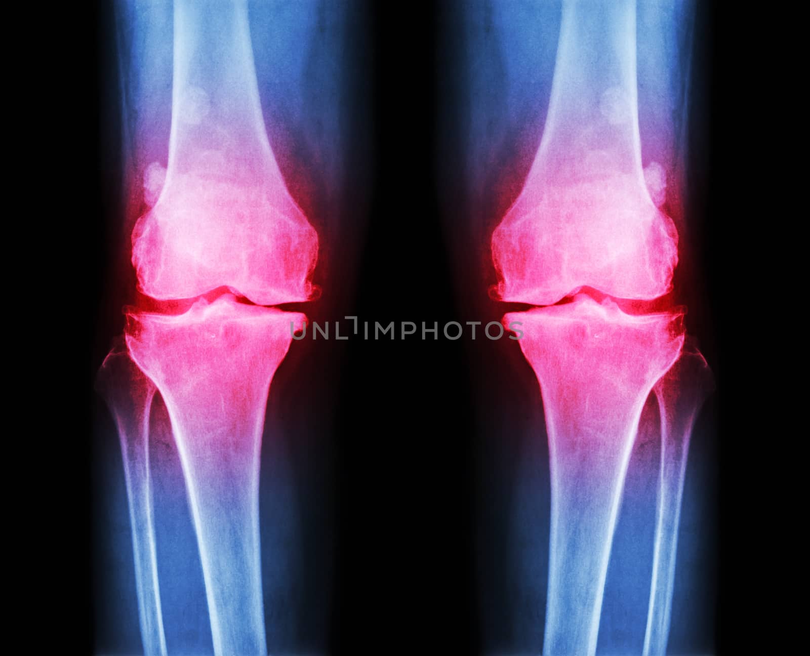 Osteoarthritis both knee . film x-ray AP ( anterior - posterior ) of knee show narrow joint space , osteophyte ( spur ) , subcondral sclerosis