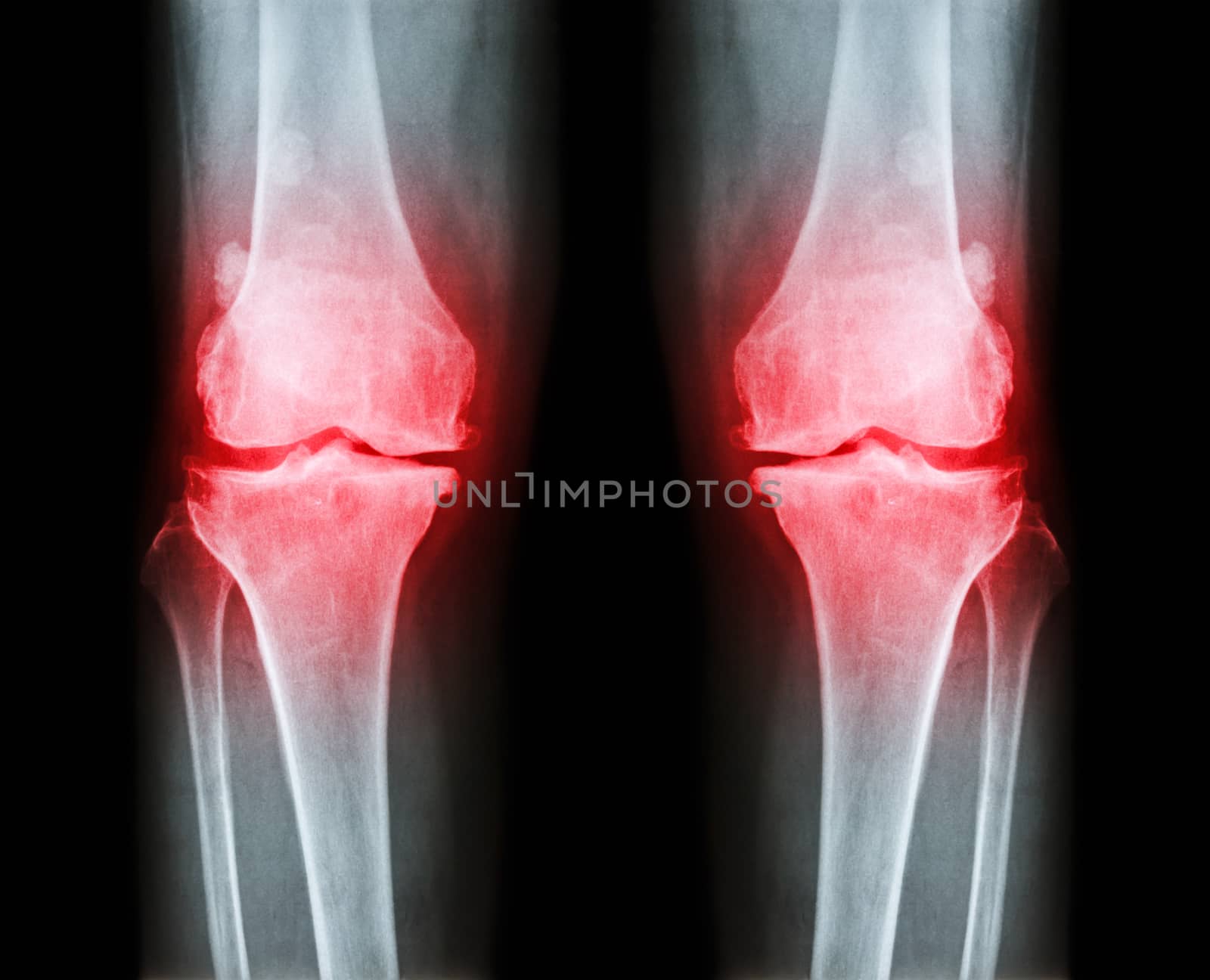 Osteoarthritis both knee . film x-ray AP ( anterior - posterior ) of knee show narrow joint space , osteophyte ( spur ) , subcondral sclerosis