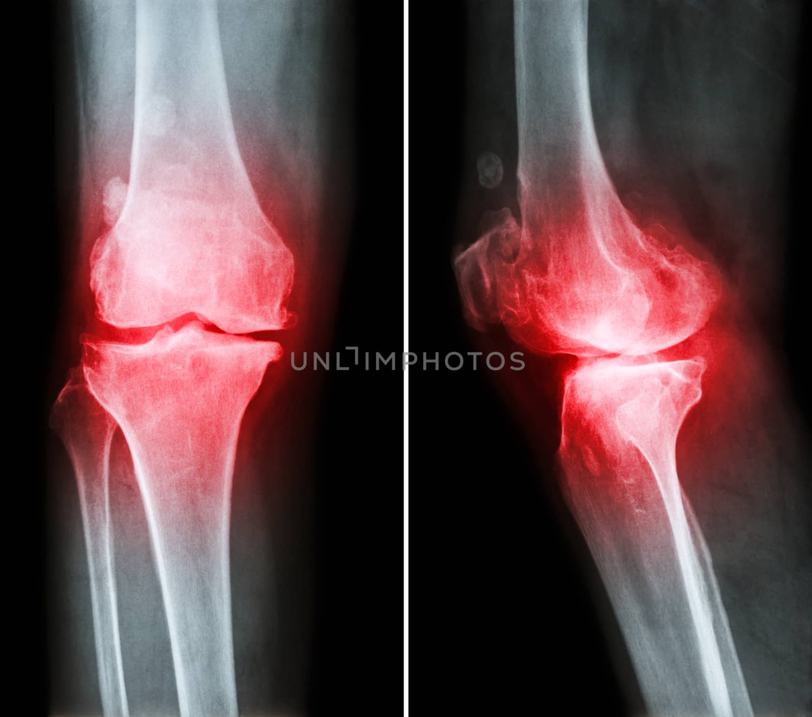 Osteoarthritis knee . film x-ray knee ( anterior - posterior and lateral view ) show narrow joint space , osteophyte ( spur ) , subcondral sclerosis due to degenerative change