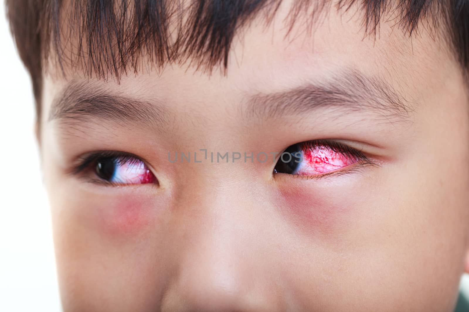 Closeup of chronic conjunctivitis with a red iris. Shallow depth of field (dof), left eye of asian child in focus. Studio shot.