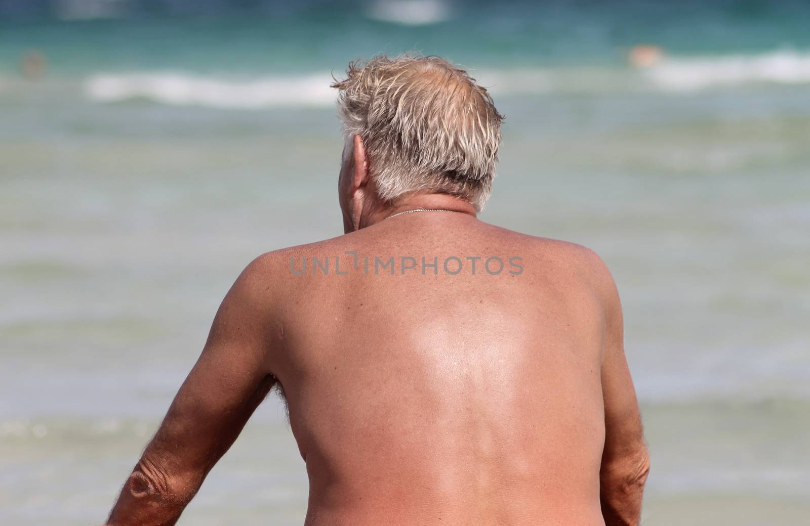 Alcudia, Majorca, Spain - 19th of August 2012. Surnburnt senior man looking out to sea in this popular tourist resort.
