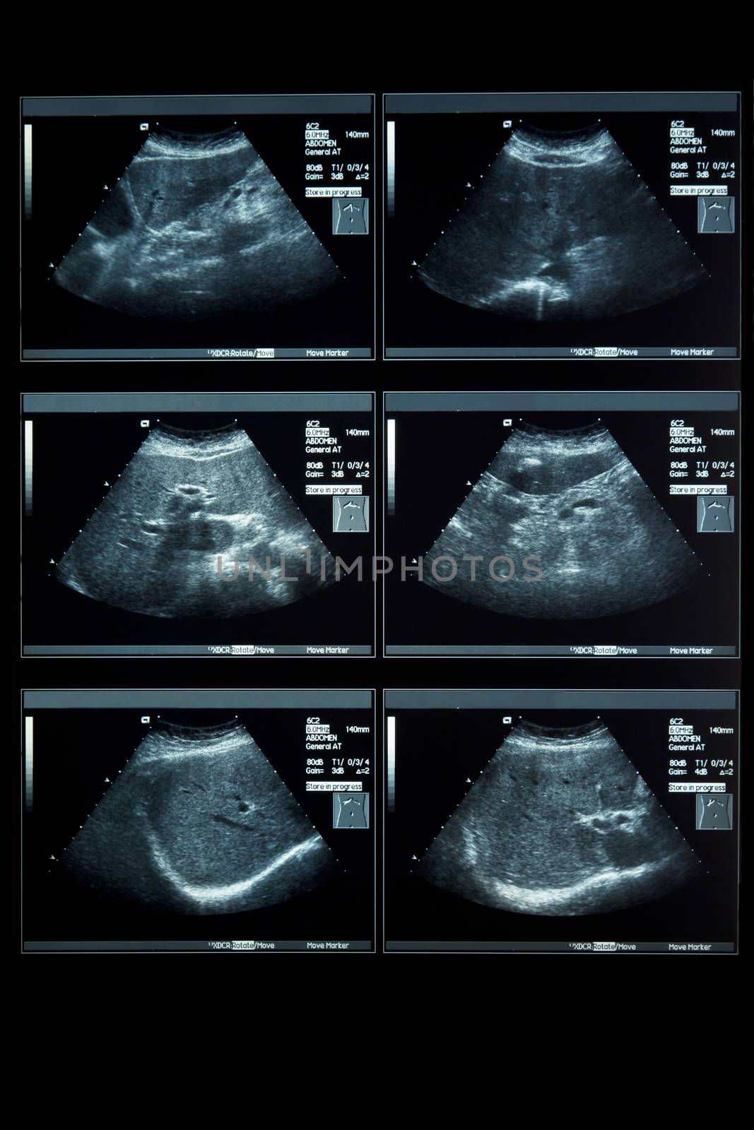 Ultrasonography Analysis of female by ekachailo